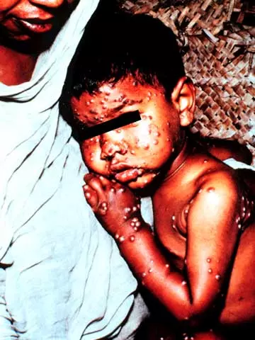 天然痘にかかった子供