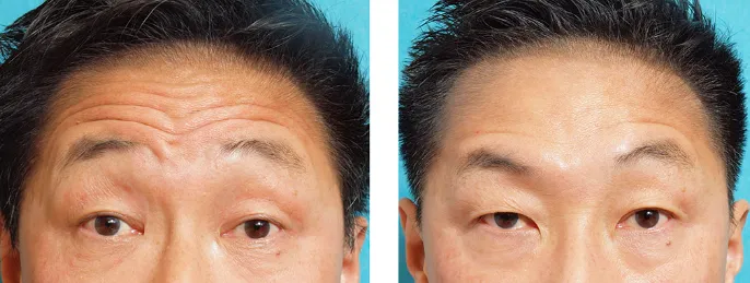 ボトックス注射