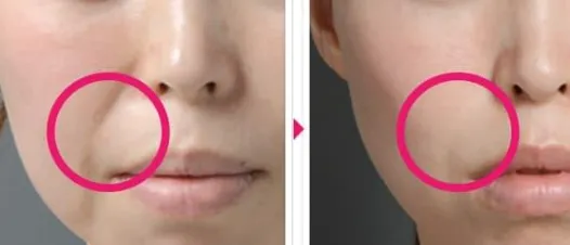 ヒアルロン酸注射