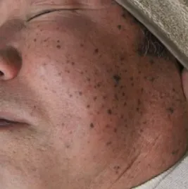 シミ・くすみ・赤み