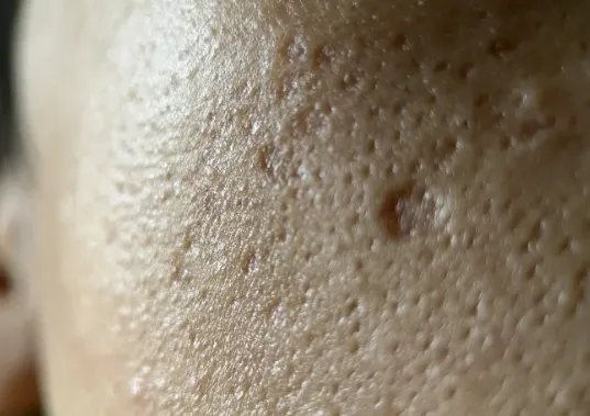 毛穴開き・クレーター