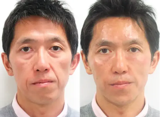 ヒアルロン酸リフト