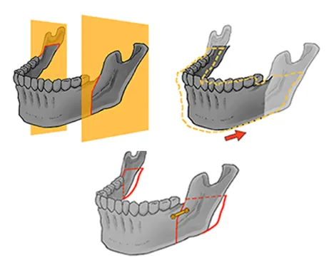 下顎骨切り手術
