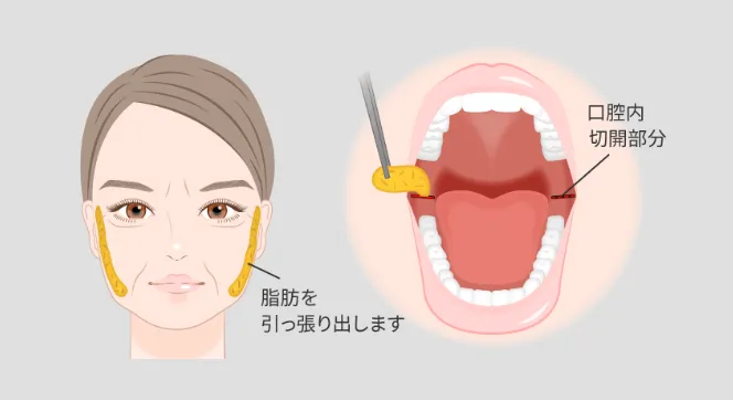 バッカルファット除去