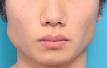 極端なエラ張り