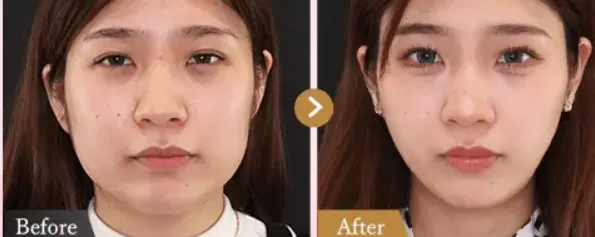 ボトックス注射