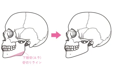 下顎角骨切り術