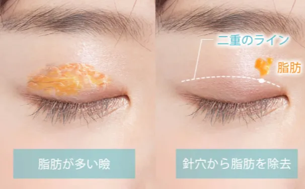 まぶたの脂肪取り