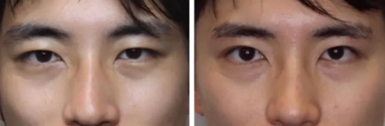 上眼瞼リフト（眉下切開）