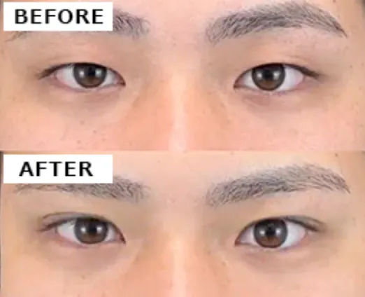 二重まぶた形成