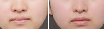 鼻翼縮小