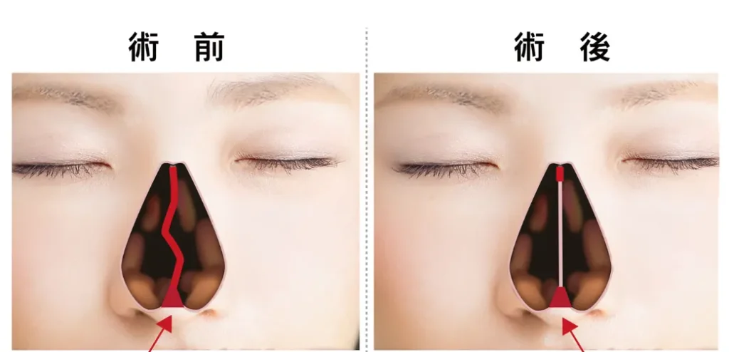 鼻中隔矯正術
