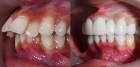 セラミック矯正