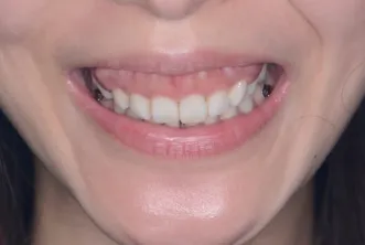 ガミースマイル