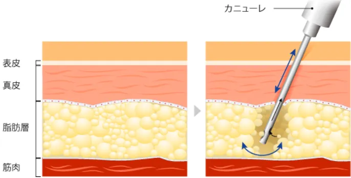 身体の脂肪吸引