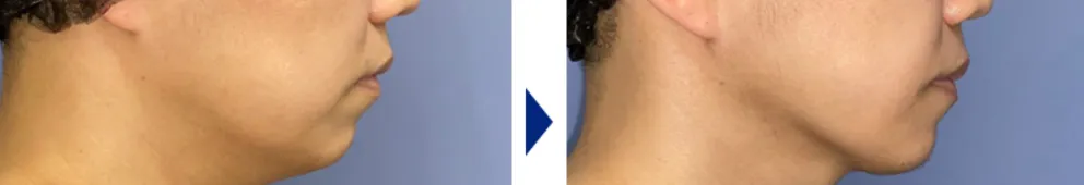 顎下の脂肪吸引