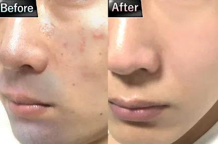 肌トラブルのカバー