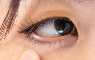 17.目の充血をおさえる